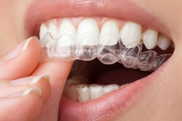 Invisalign Image